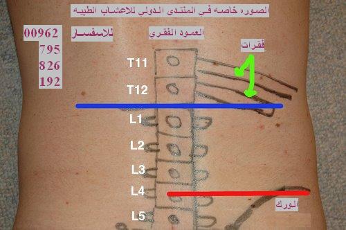 كسر الفقرة الانضغاطي هو كسر يحدث في فقرة